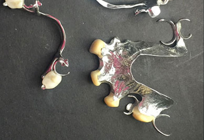 proteza szkieletowa górna i dolna 